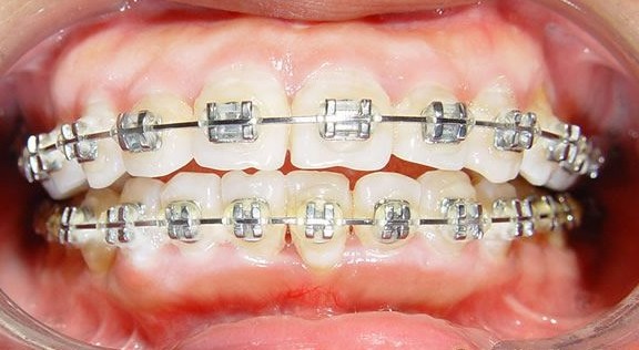 隐形矫正危害-皮肤白牙齿,隐形牙齿矫正的危害
